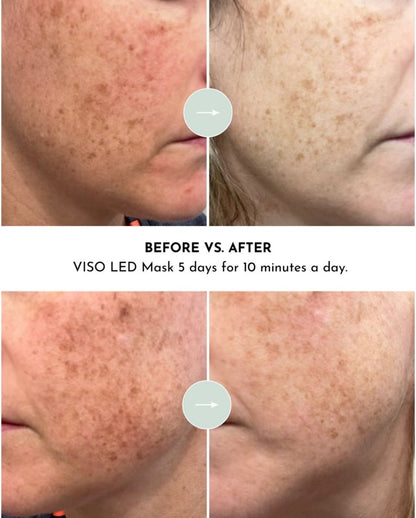 VISO 660nm Red Light Face Mask